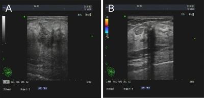 Breast Metastasis From Rectal Signet-Ring Cell Carcinoma: A Case Report and Review of Literature